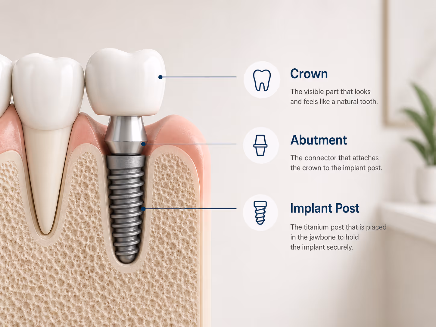 Dental Implant