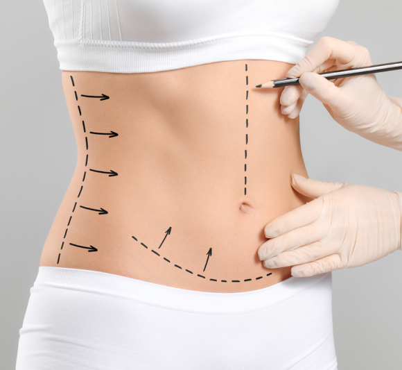 Close-up of a woman’s midsection with surgical markings on the abdomen for a tummy tuck procedure, while a gloved hand holds a marker.
