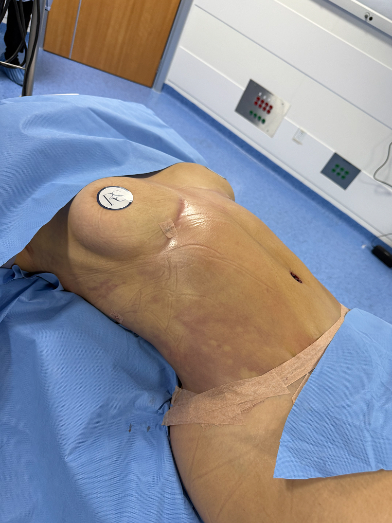 Person lying face down on an operating table with blue surgical drapes covering lower back and buttocks.