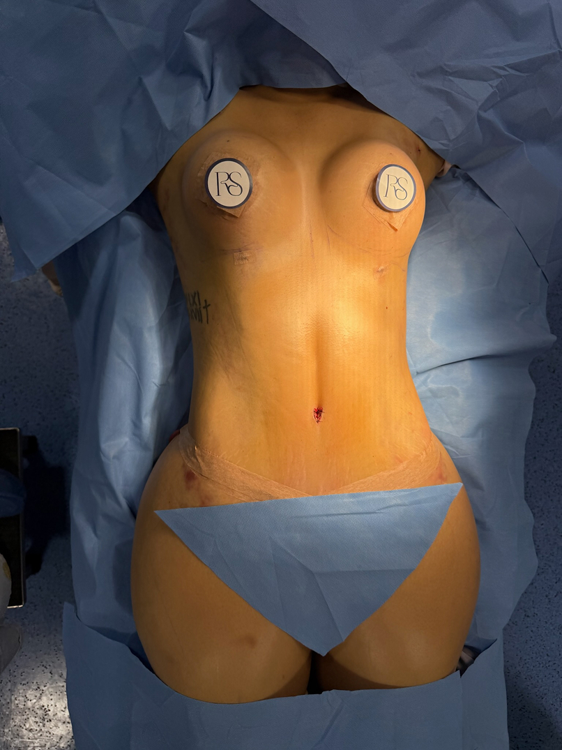 Patient lying on surgical table with marked chest and abdomen, covered with blue sterile drapes.