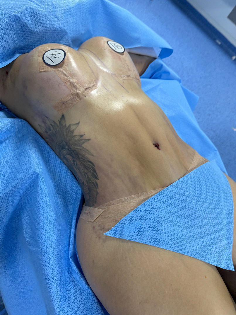 Patient lying on side partially covered with blue surgical drapes in an operating room.