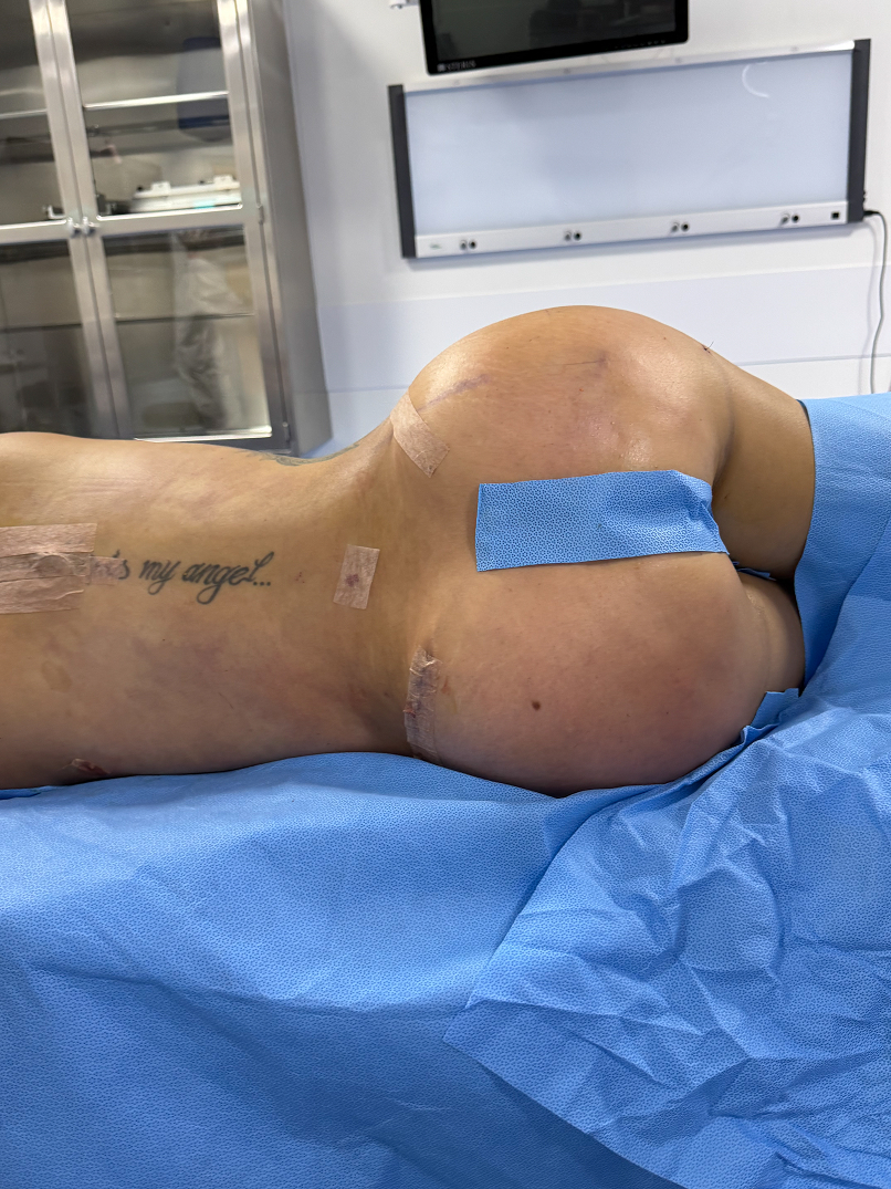 Patient lying sideways on surgical table with blue drapes covering lower body in a clinical room.