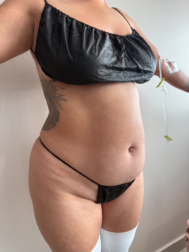 Woman with braided hair wearing black crop top, black underwear, and white thigh-high stockings, with medical marking lines on her abdomen and hips.