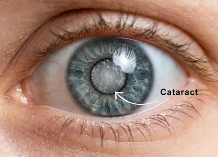 Cataract Surgery