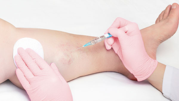 Sclerotherapy injection