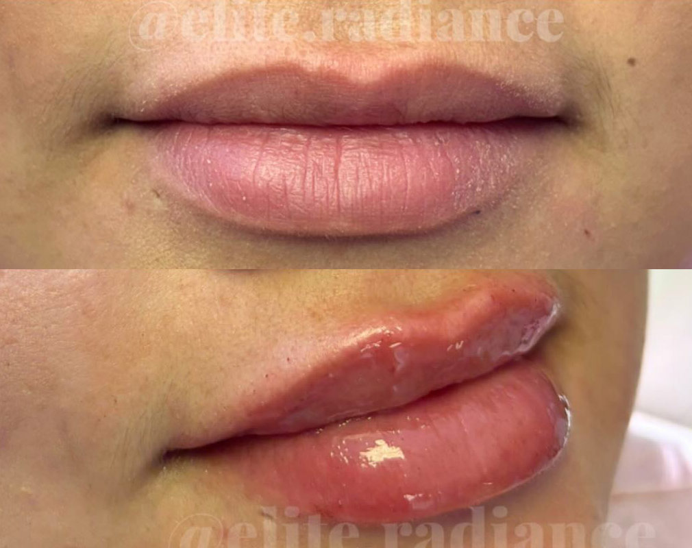 Before and after lip fillers