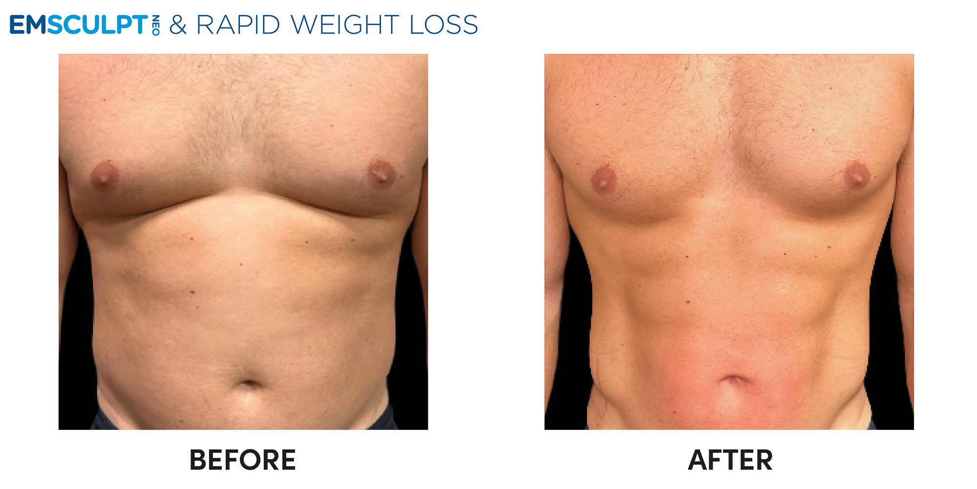 Before and after emscuplt abs