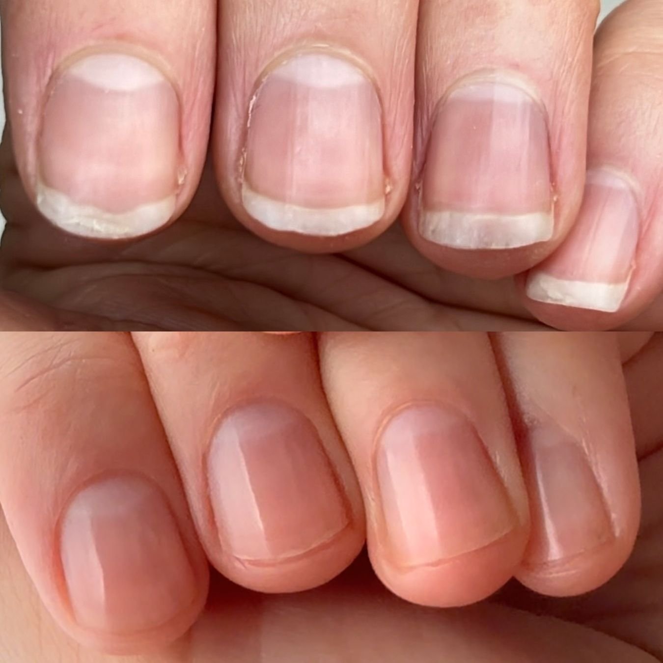 Close-up comparison of fingernails before and after treatment, showing nails with white edges and ridges above, and smooth, healthy nails below.