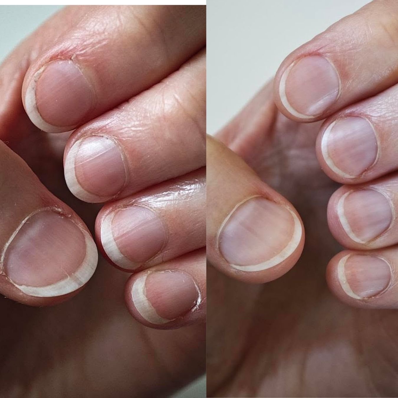 Close-up comparison of fingernails before and after treatment, showing healthier nails on the right side.