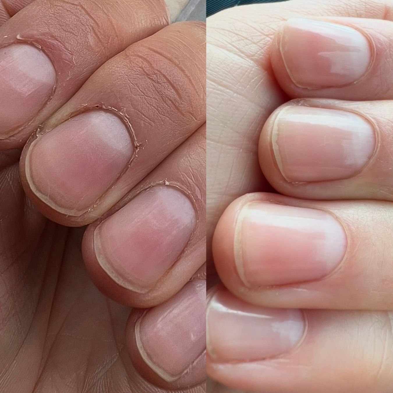 Side-by-side close-up comparison of fingernails showing dry, peeling cuticles on the left and healthy, smooth cuticles on the right.