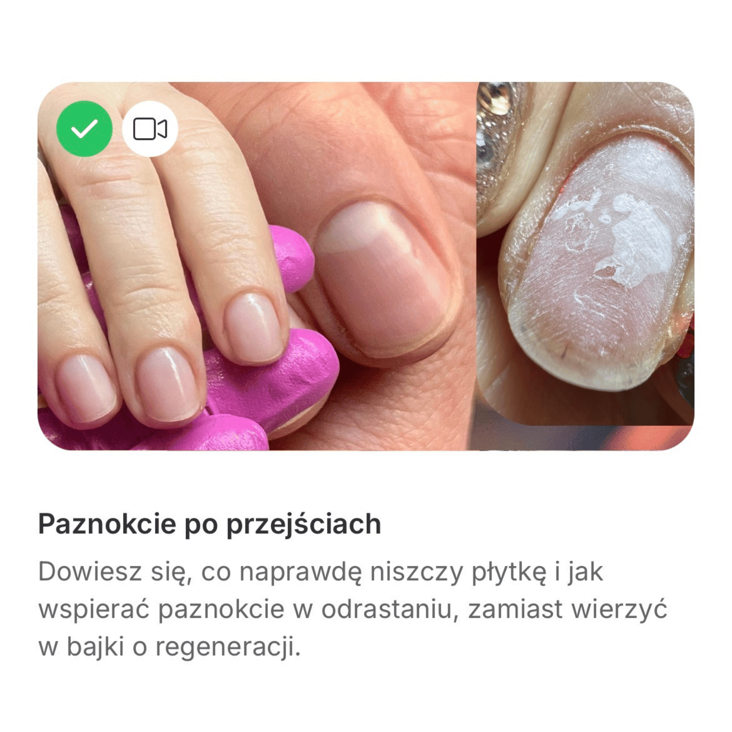 Comparison of healthy natural nails on fingers and a damaged fingernail with peeling and discoloration.