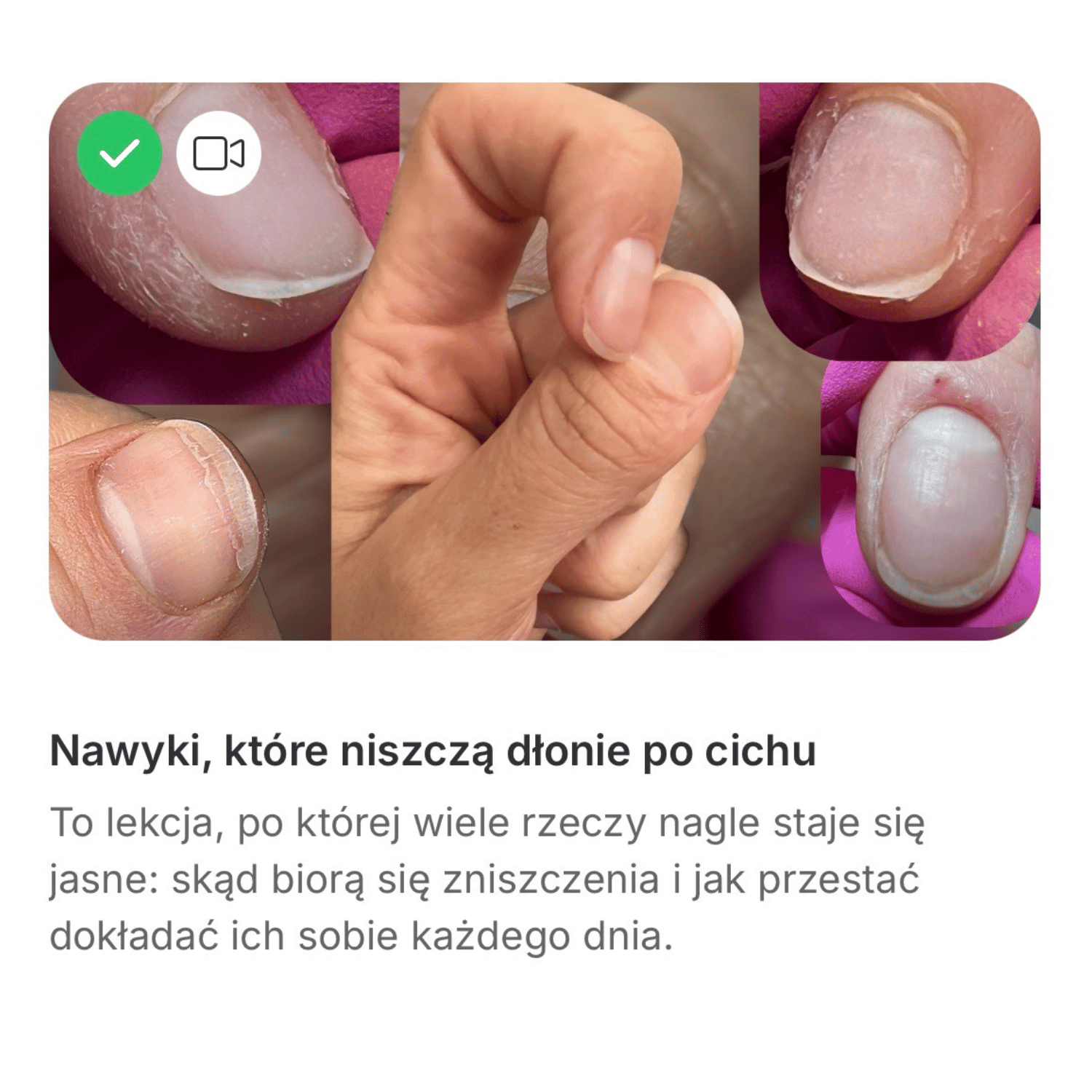 Collage showing damaged fingernails with peeling and rough edges surrounding a clenched hand, illustrating nail biting and skin picking habits.