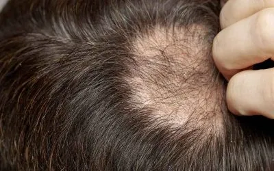Alopecia