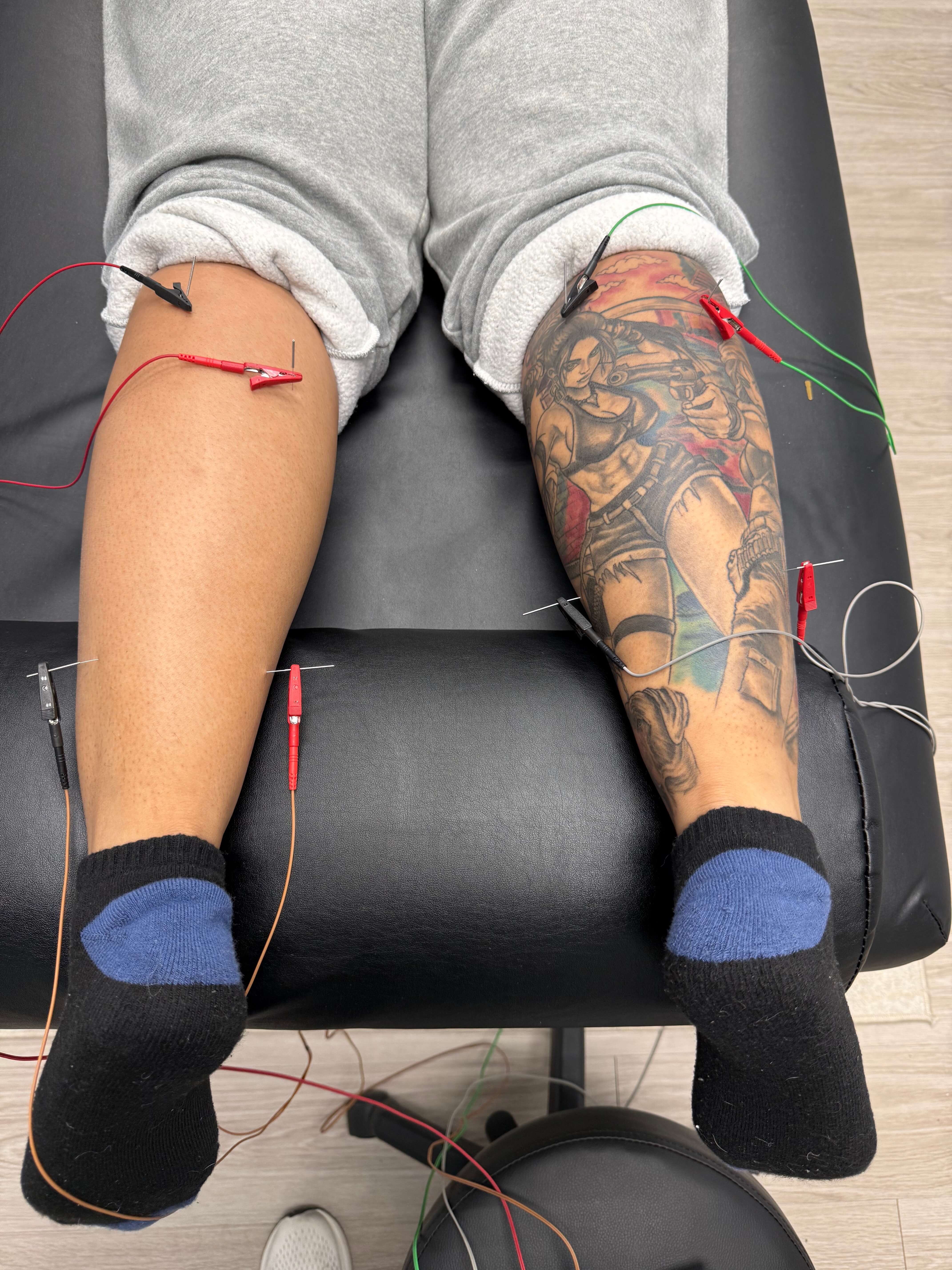 Person lying face down on a black treatment table with acupuncture needles and electrode clamps attached to the calves, the right leg has a detailed tattoo of a female character holding a gun.