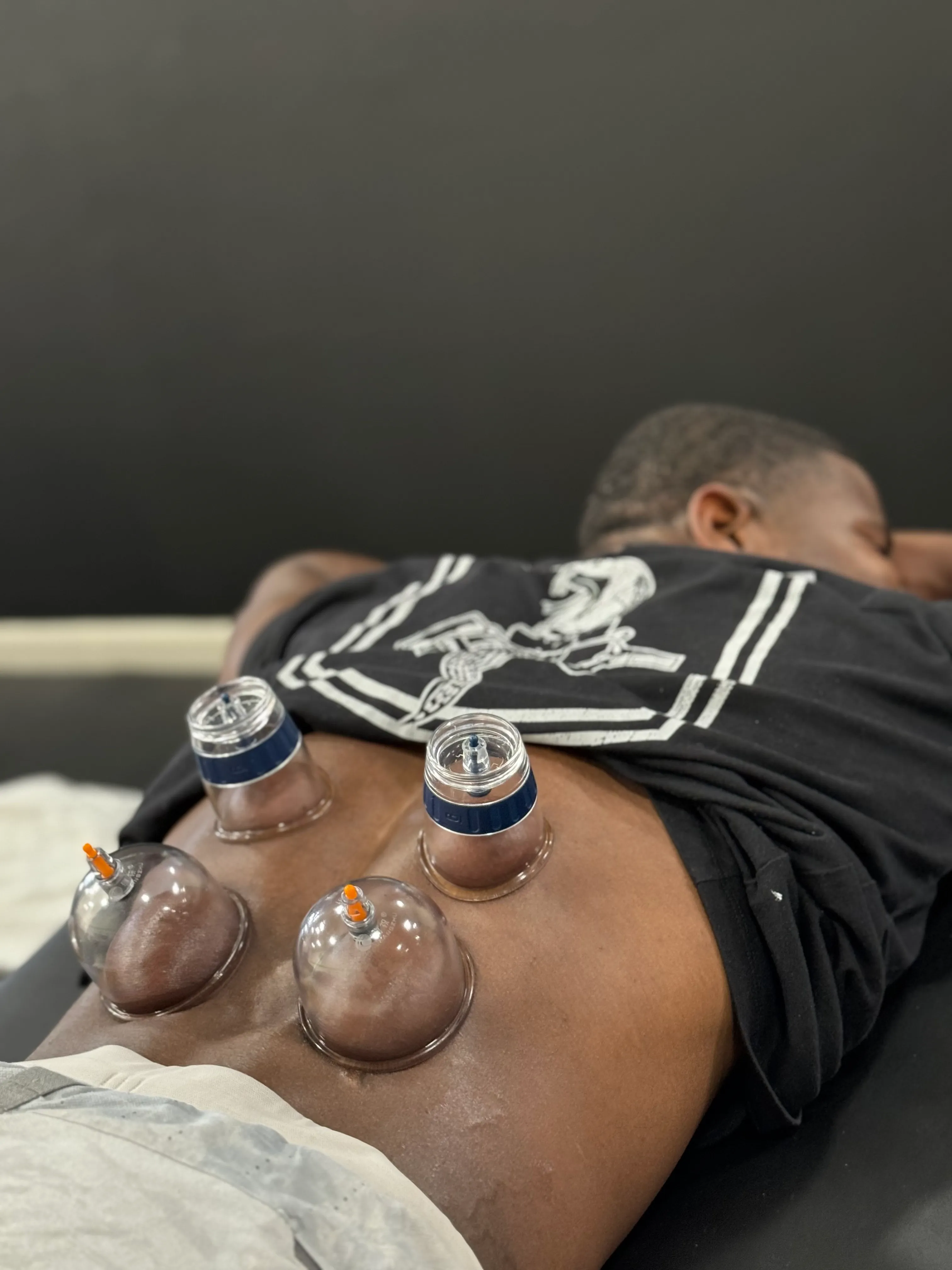 Man lying face down receiving cupping therapy with four suction cups on his back.