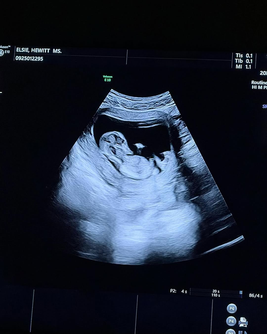 Infertility & Fertility