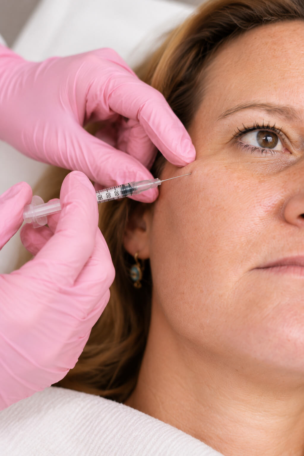 Medical provider performing an injectable lip treatment to soften vertical lip lines and improve lip support and definition.
