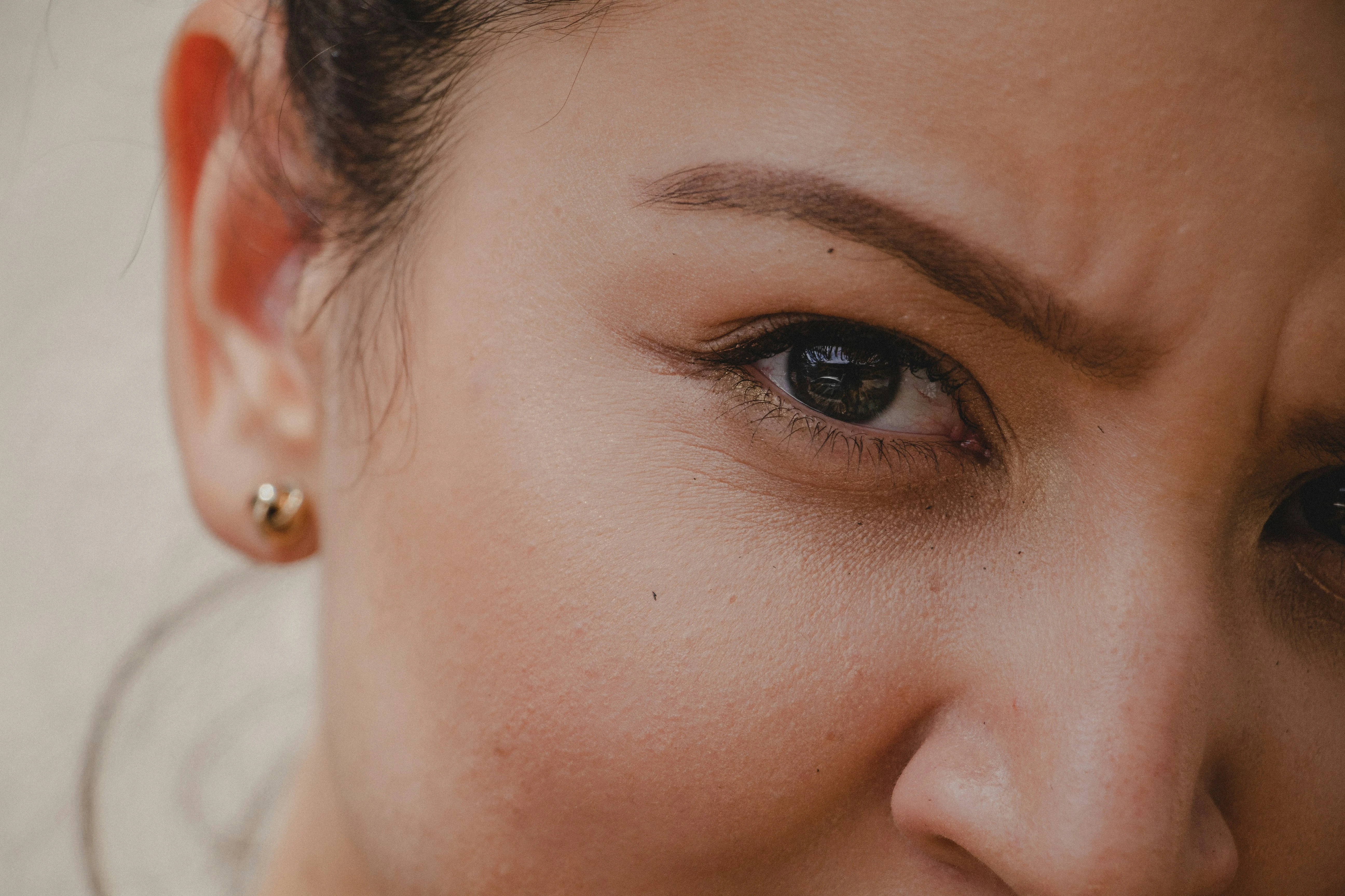 Close-up of crow’s feet and fine lines around the eyes before botox treatment