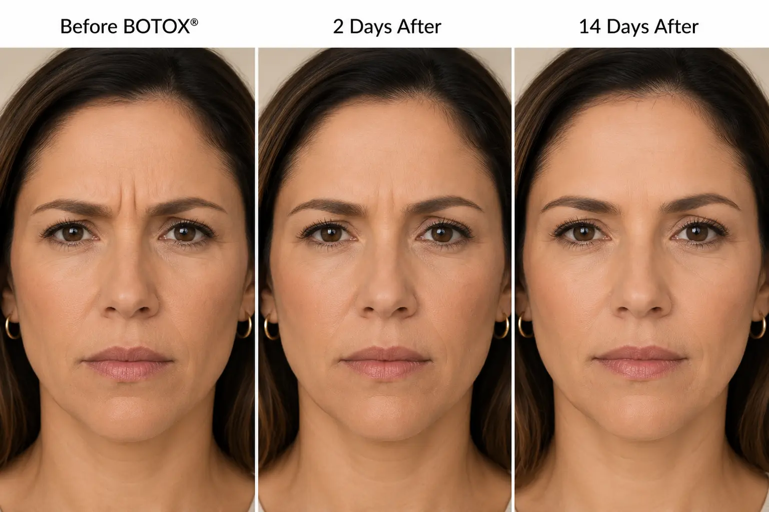 Botox forehead before and after comparison showing results before treatment, 2 days after injections, and 14 days after with smoother forehead lines.
