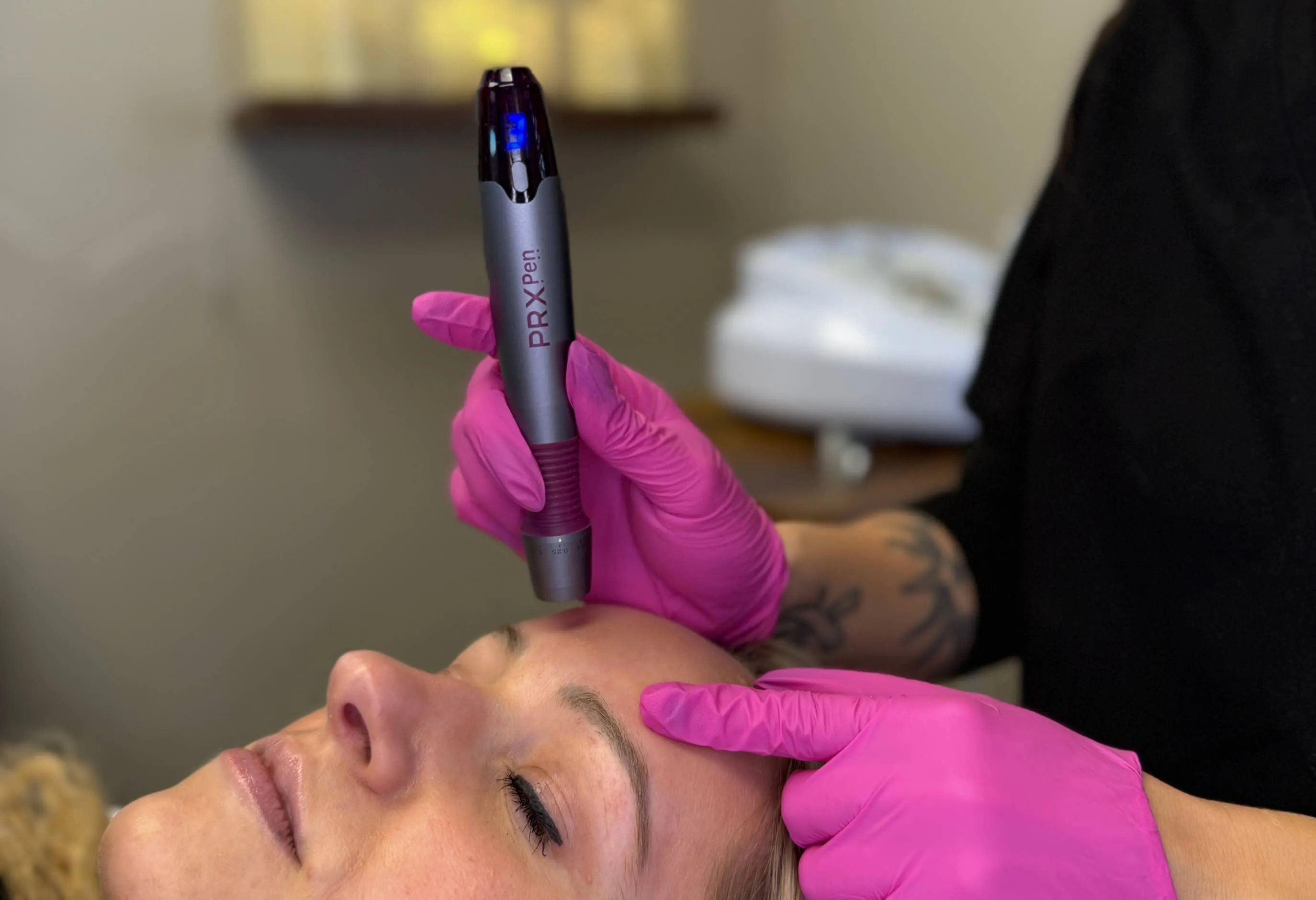 PRX Derm Perfexion treatment being performed with the PRX Pen for non-invasive skin rejuvenation and collagen stimulation