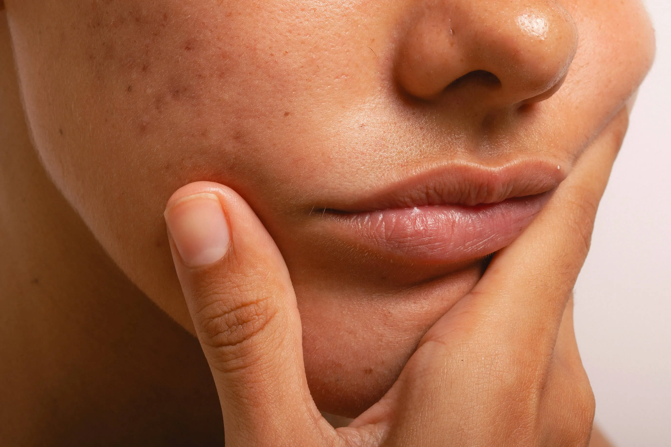 Close-up of acne scars and uneven skin texture that may improve with PRX skin rejuvenation or microneedling treatments