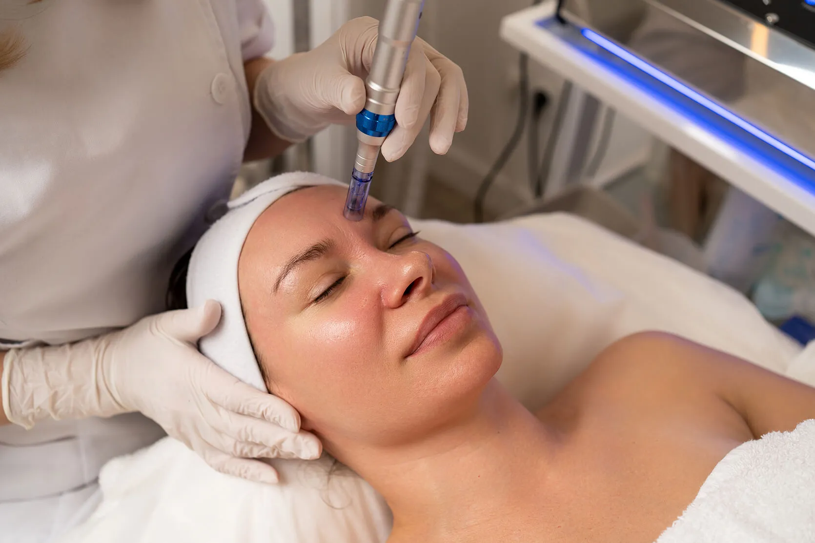 Professional microneedling treatment being performed to improve fine lines, skin texture, and overall skin quality