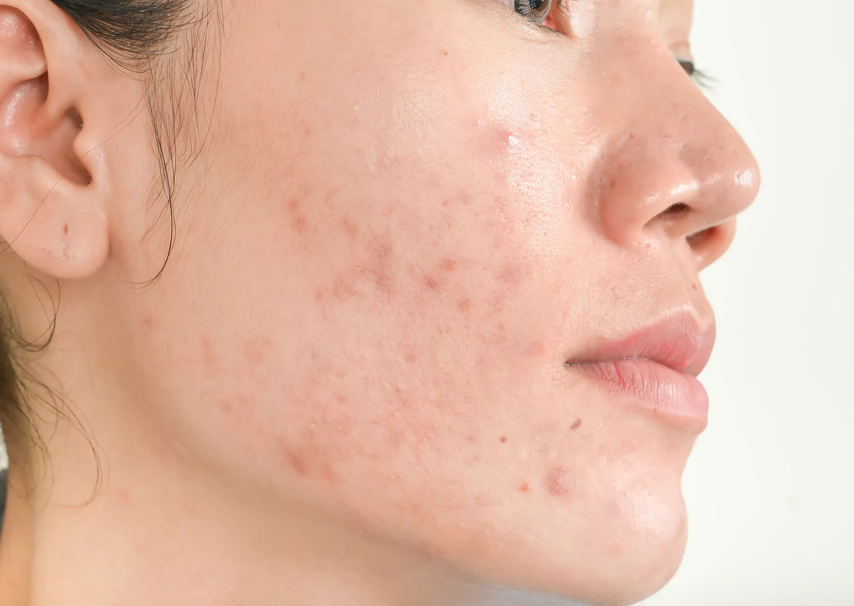 Close-up of acne scars and uneven skin texture that may improve with a personalized series of microneedling treatments