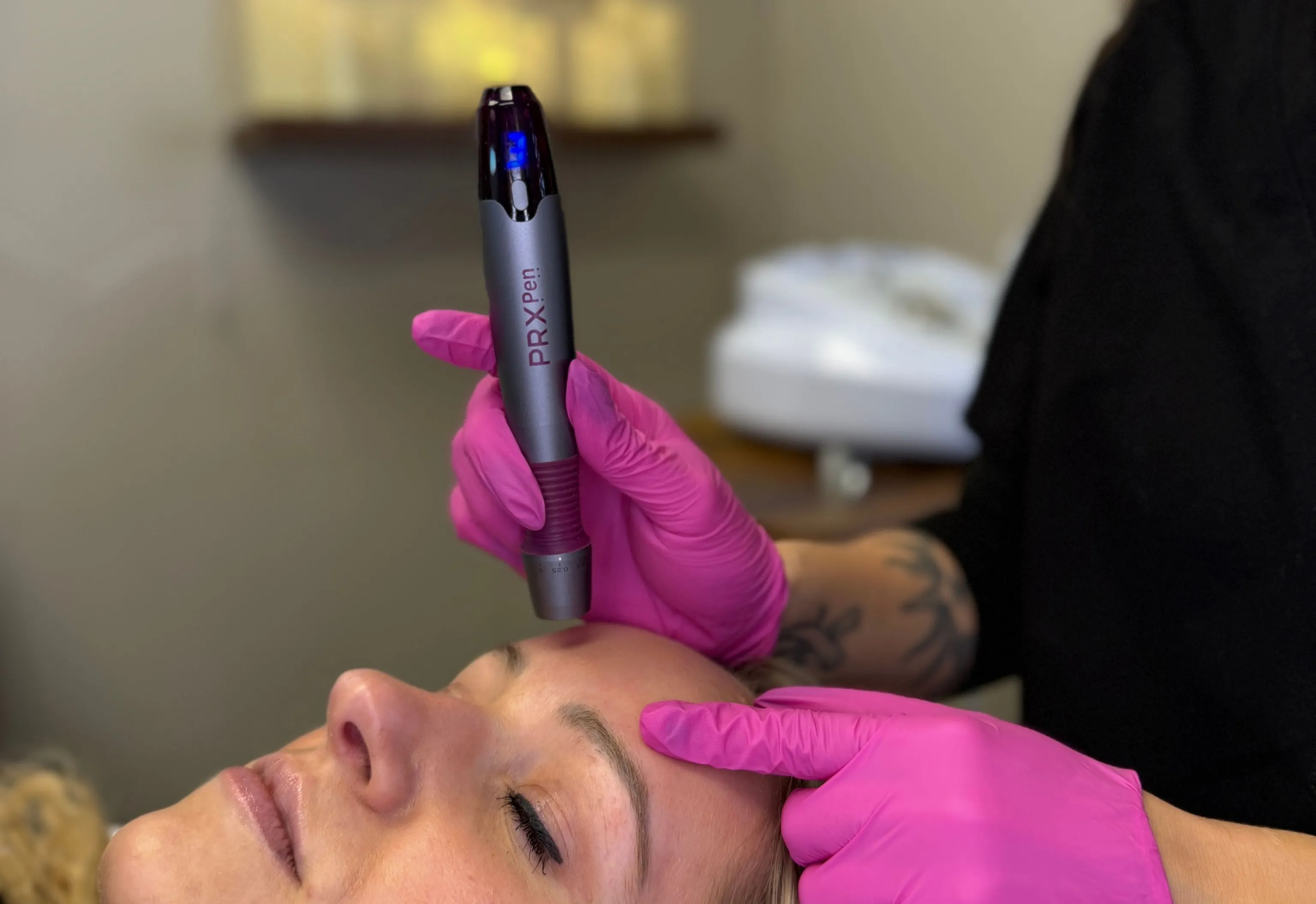 PRX Pen used during a microneedling skin rejuvenation treatment to improve skin texture and stimulate collagen production