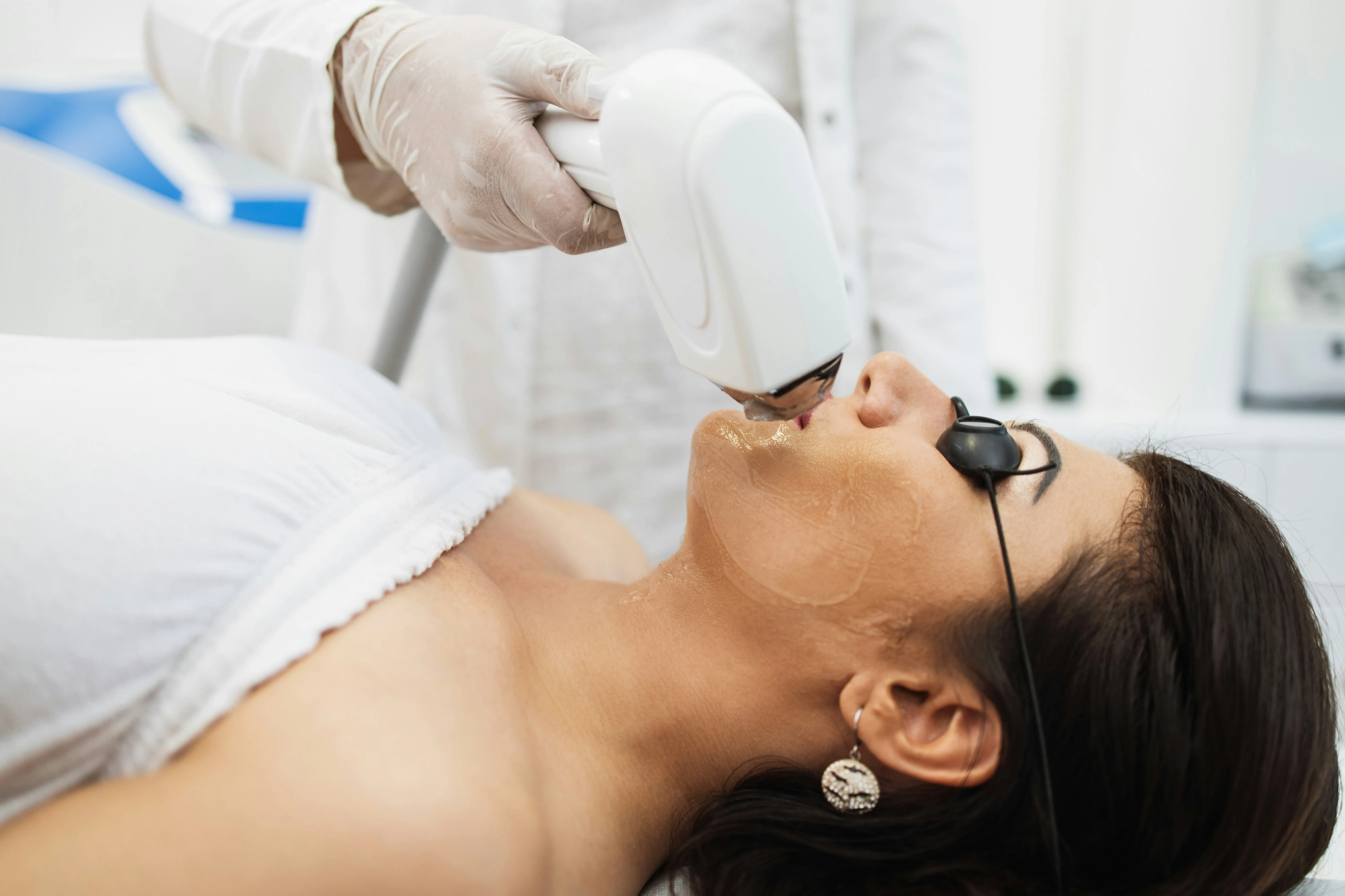 IPL skin rejuvenation treatment targeting pigmentation and uneven skin tone caused by sun exposure