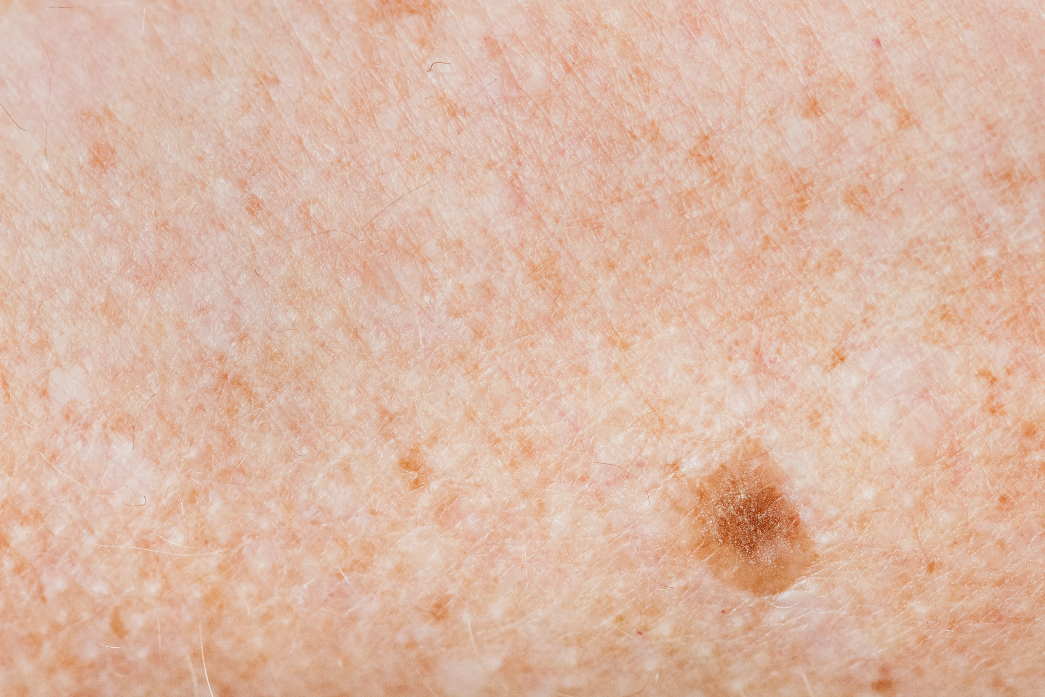 Close-up of an age spot and sun-damaged skin that may be treated with IPL photofacial treatments