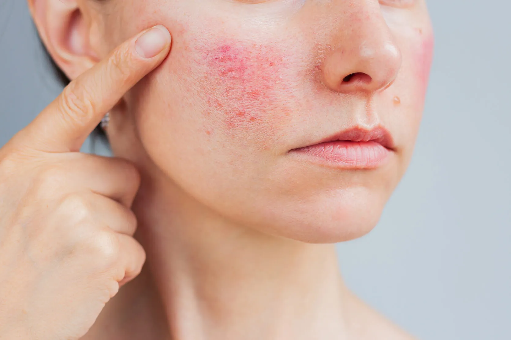 Close-up of facial redness and rosacea that may be improved with IPL treatment
