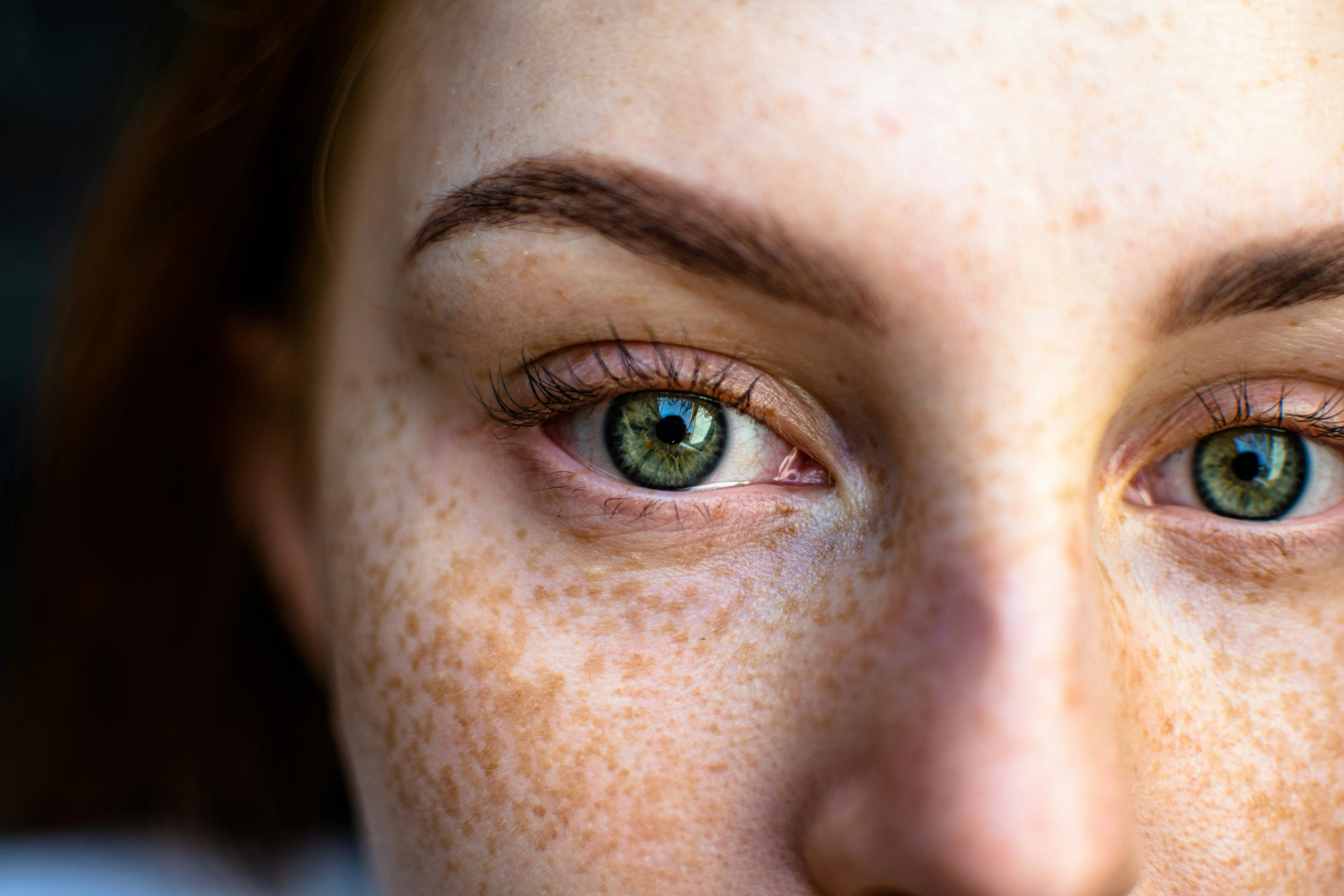 Facial sun damage and freckles that may improve with IPL treatment for pigmentation concerns
