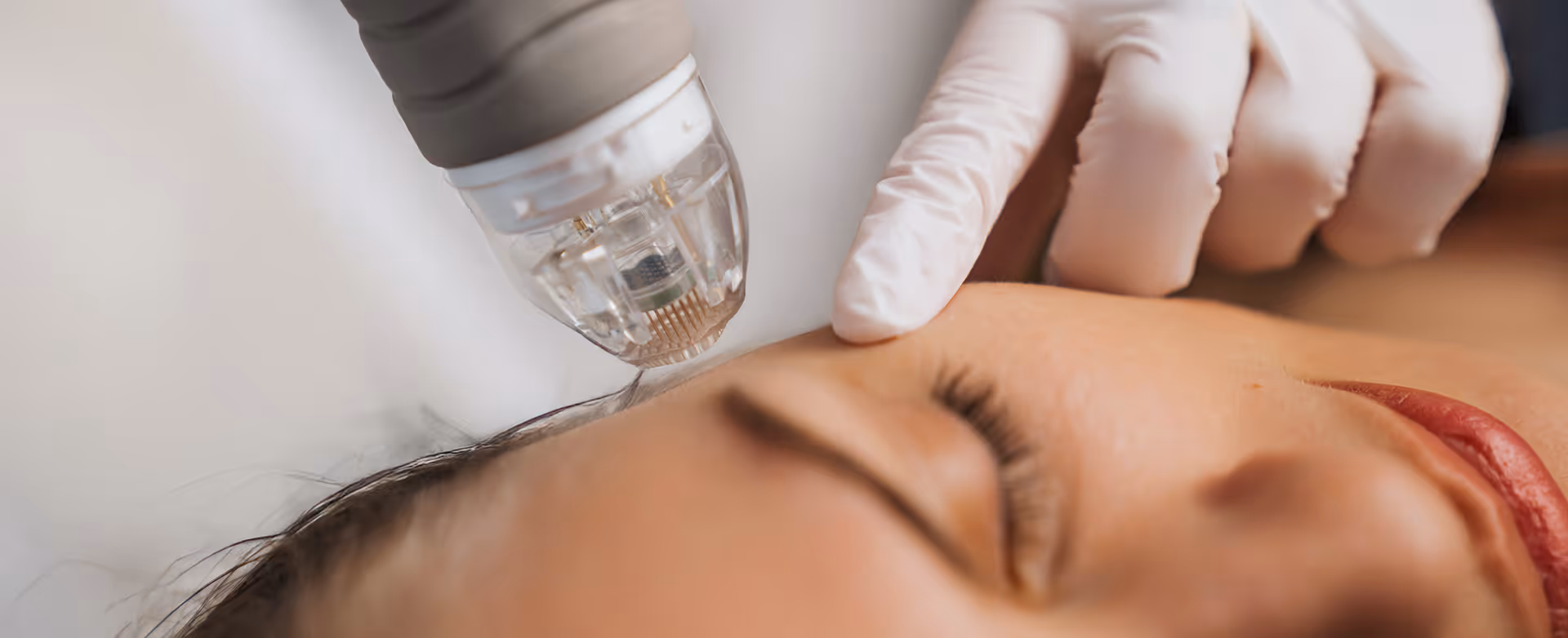 Close-up of a woman receiving a microneedling facial treatment on her forehead by a gloved hand.