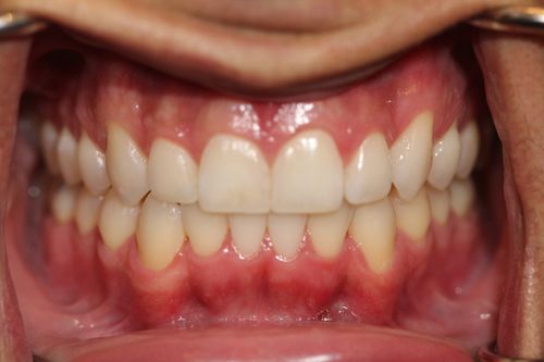 After image | Visit for cosmetic dentistry in Encinitas, CA.