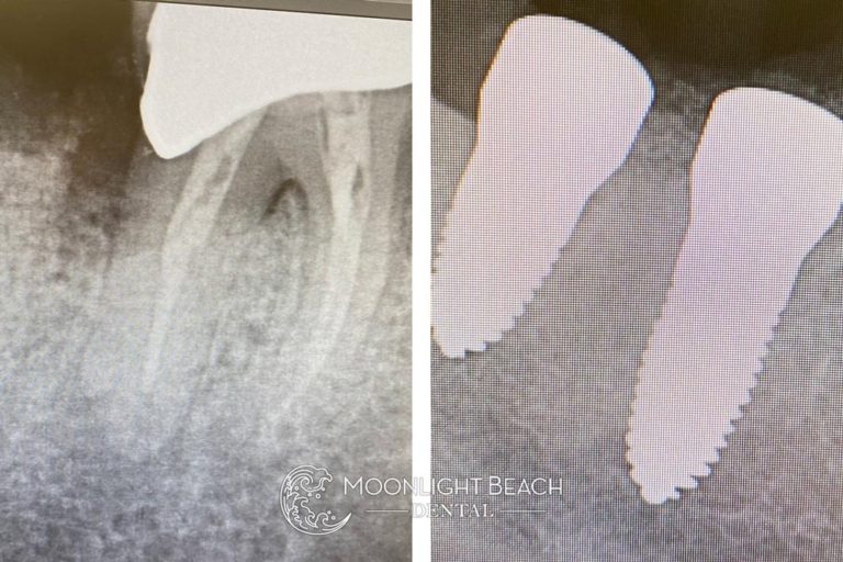 Before & After: Infected Root Canal & Ceramic Implants