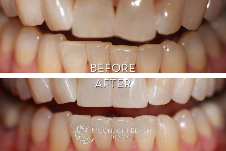 Before & After: Bonding & Invisalign