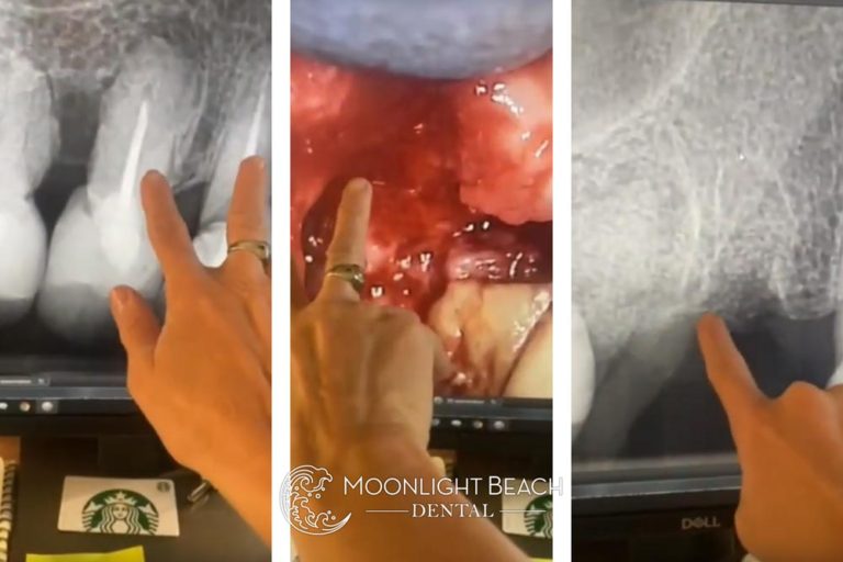 Root Canal Infection: Cyst, Extraction & Prep for Dental Implants