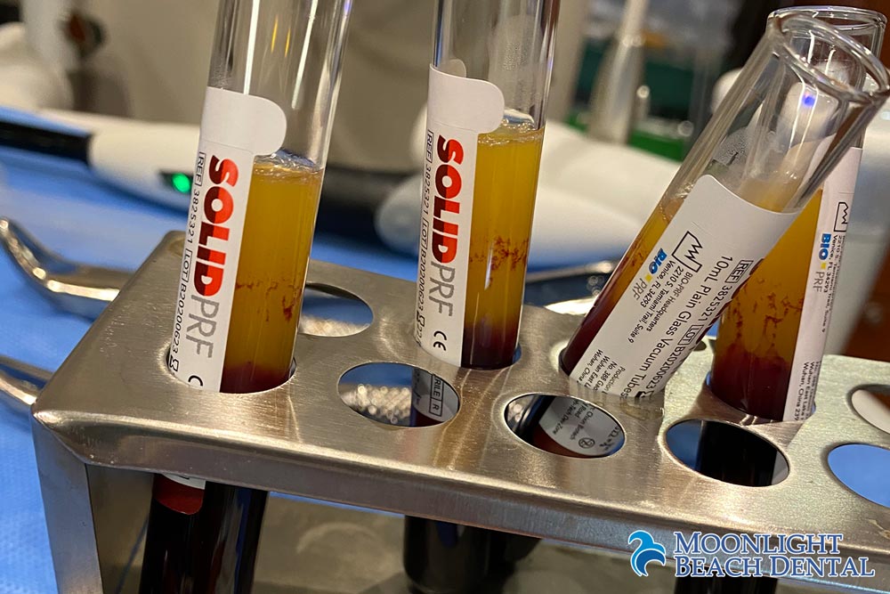 Different Bone Grafting For Teeth