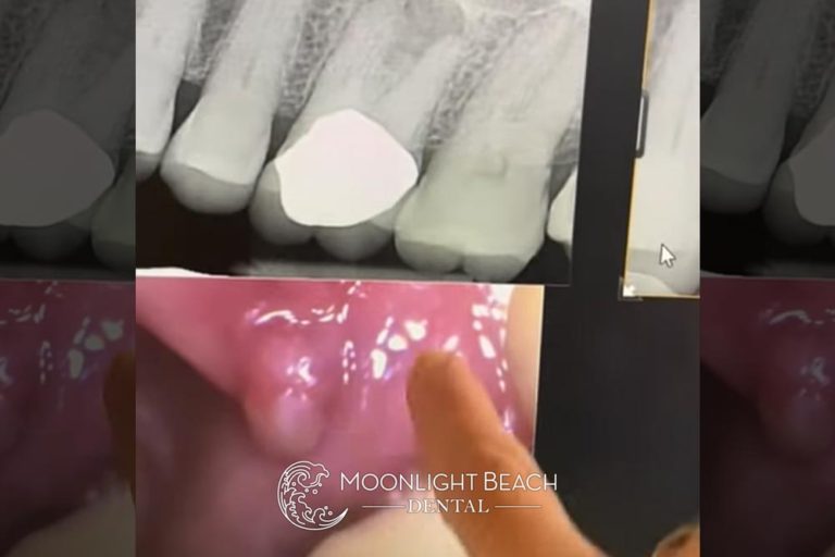 Fistula In The Gum From Root Canal Infection