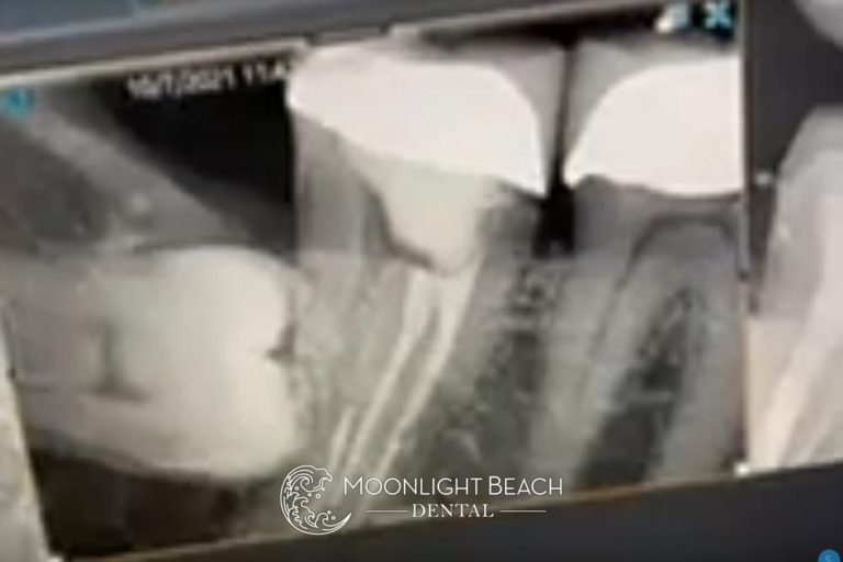 This Sort Of Thing Gives Root Canals A Bad Rap