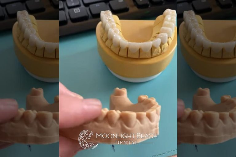 Before & After: Full Smile Transformation
