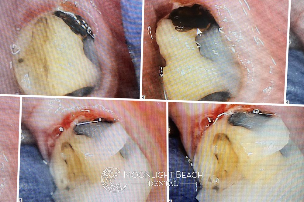 When Your Tooth Turns Black With Bacteria… Time For A New Dentist!
