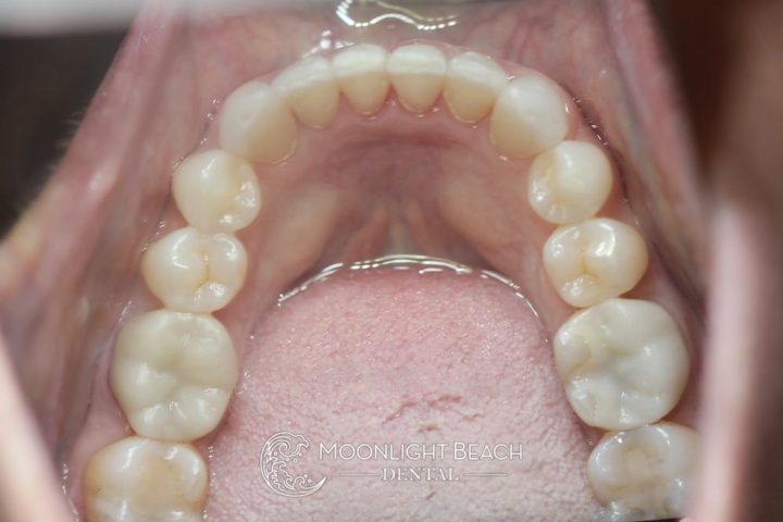 Pic shows straightened teeth after Invisalign.