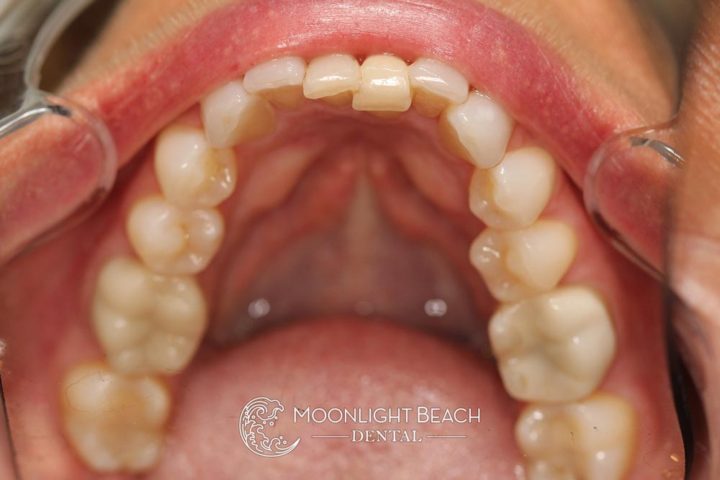 Pic shows crowded, jagged bottom teeth before Invisalign.