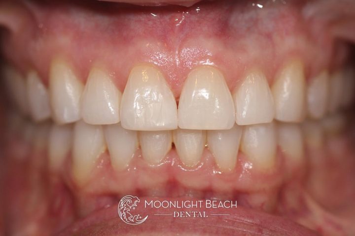 Pic shows straightened teeth after Invisalign.