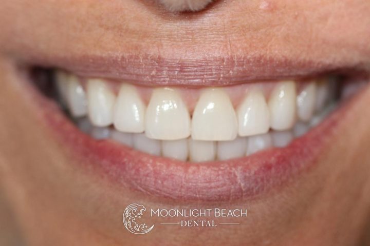 Pic shows straightened teeth after Invisalign.