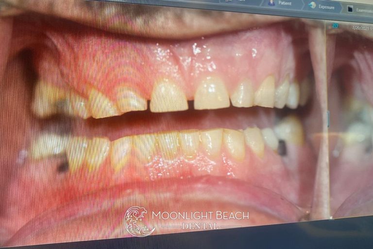 A Smile Makeover In Progress