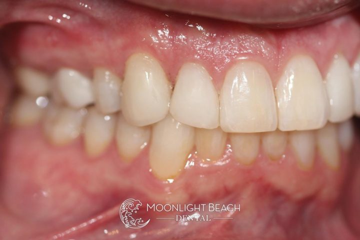 Before & After: Closing Gaps Between Teeth