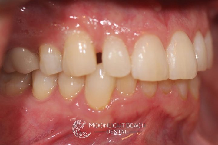 Before & After: Closing Gaps Between Teeth