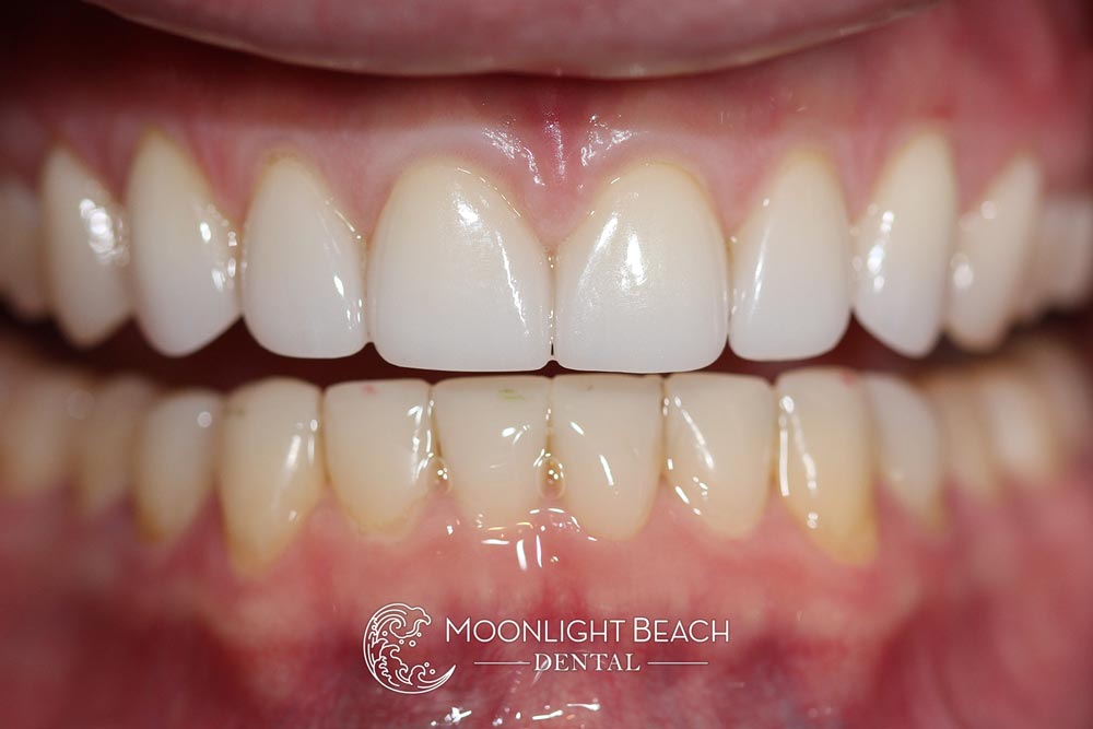 One Year Later: Conservative Smile Makeover